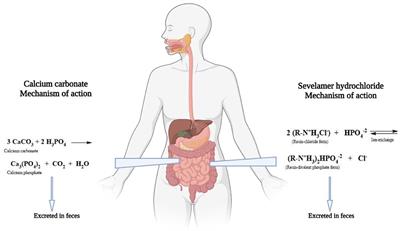 The Influence of Sevelamer Hydrochloride and Calcium Carbonate on Markers of Inflammation and Oxidative Stress in Hemodialysis at Six Months of Follow-Up